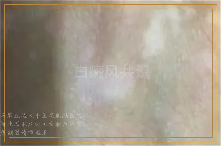 白癜风共识
