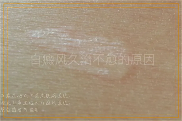 白癜风久治不愈的原因