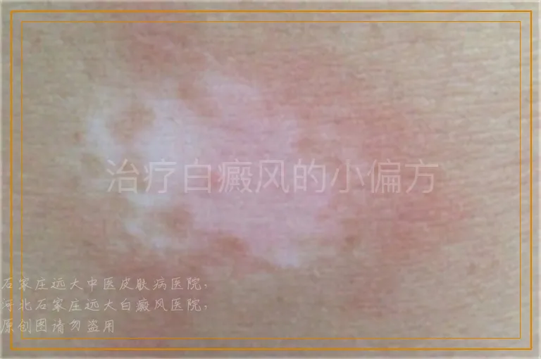 治疗白癜风的小偏方
