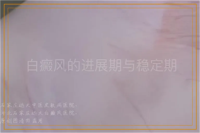 白癜风的进展期与稳定期