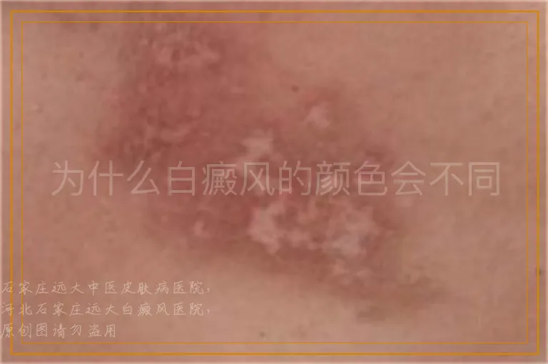 为什么白癜风的颜色会不同