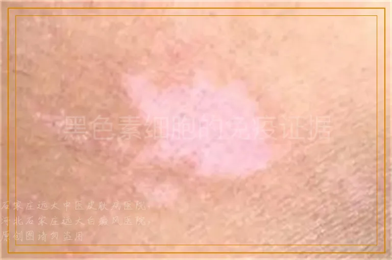 黑色素细胞的免疫证据