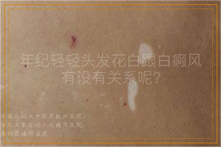 年纪轻轻头发花白跟白癜风有没有关系呢?
