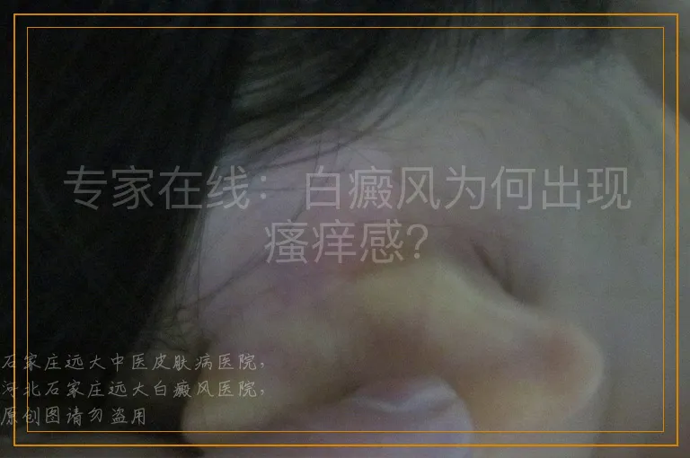 专家在线：白癜风为何出现瘙痒感？