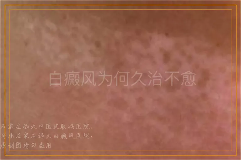 白癜风为何久治不愈