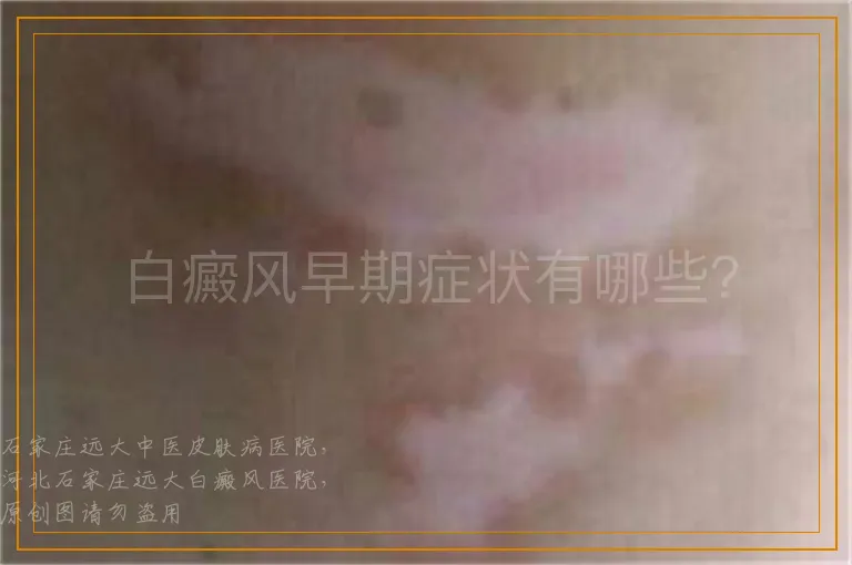 白癜风早期症状有哪些？