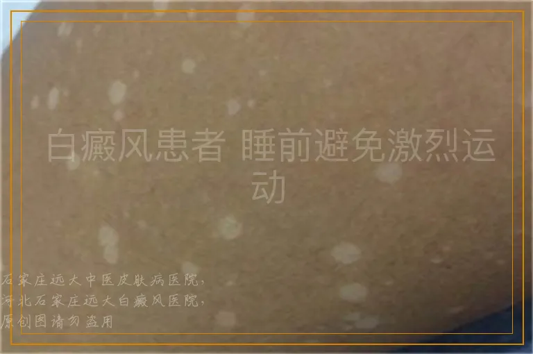 白癜风患者 睡前避免激烈运动