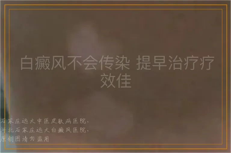 白癜风不会传染 提早治疗疗效佳