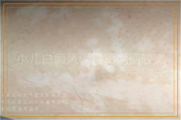 小儿白癜风误诊率为何较高