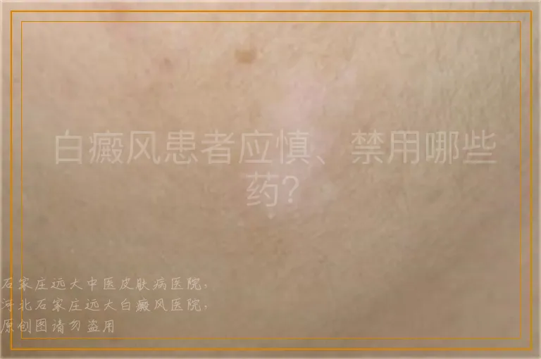 白癜风患者应慎、禁用哪些药？