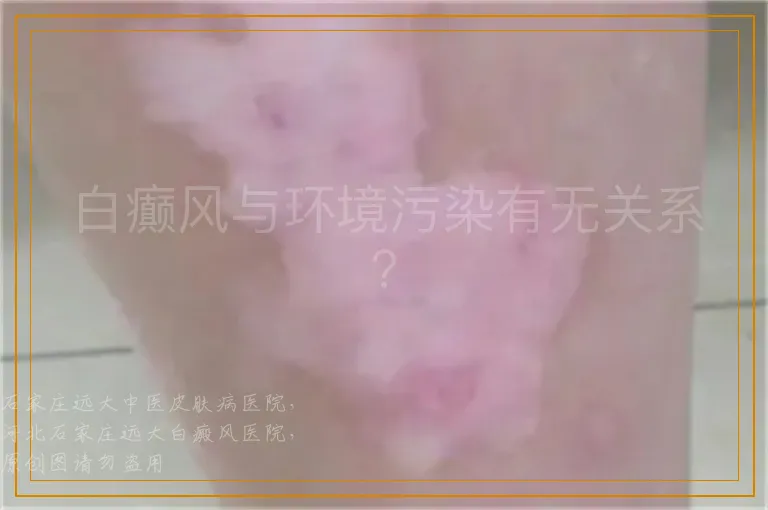 白癫风与环境污染有无关系？