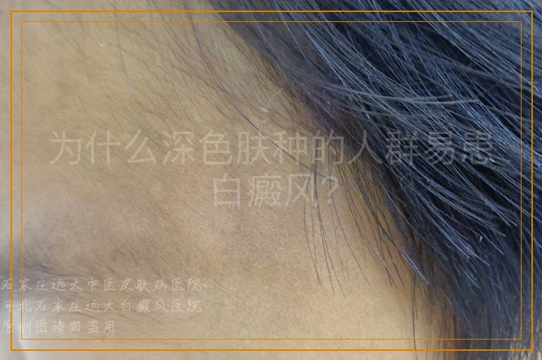 为什么深色肤种的人群易患白癜风？