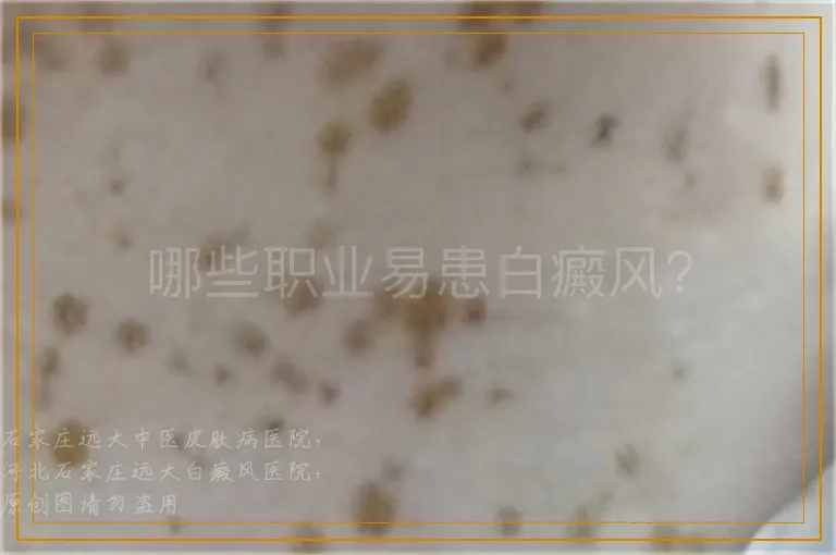 哪些职业易患白癜风？