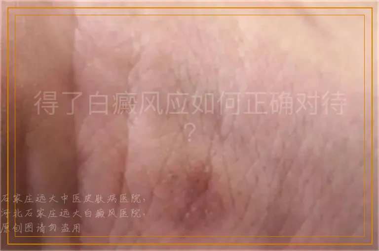 得了白癜风应如何正确对待？