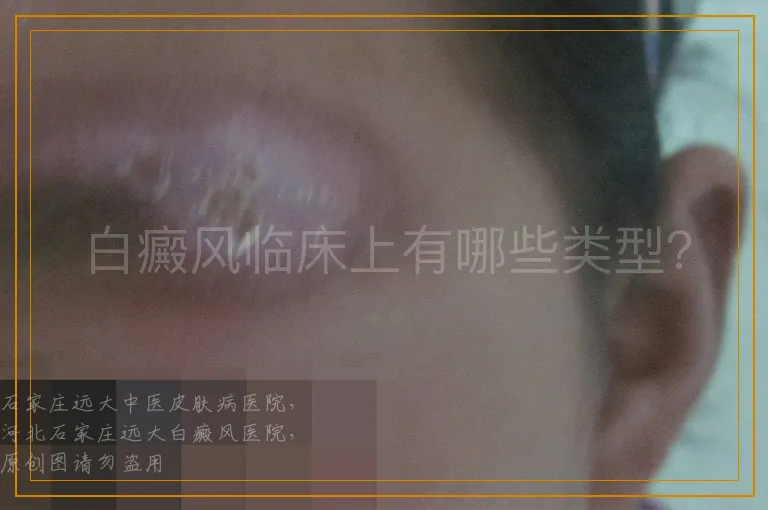白癜风临床上有哪些类型？