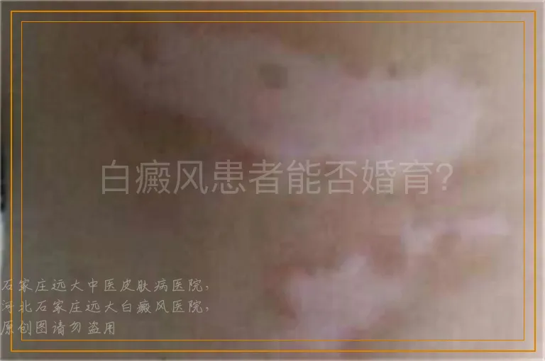白癜风患者能否婚育？