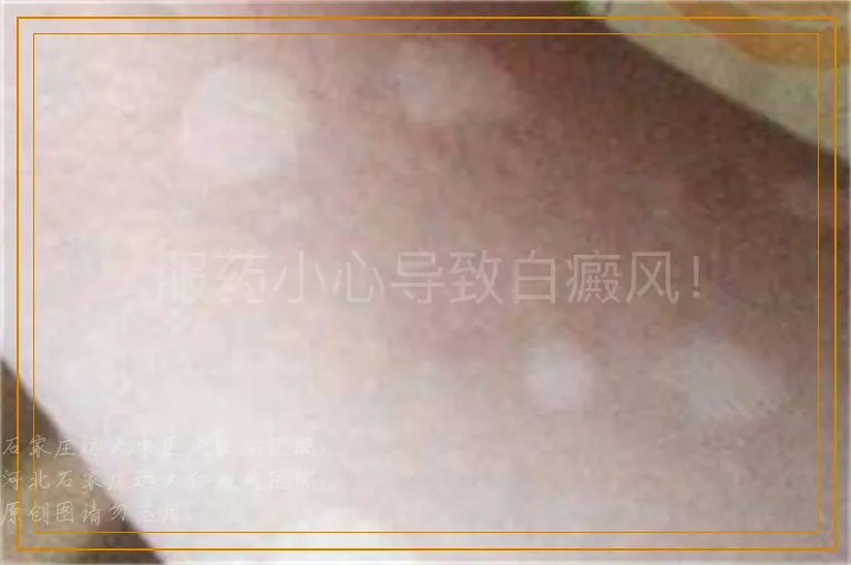 服药小心导致白癜风！