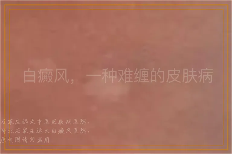 白癜风，一种难缠的皮肤病