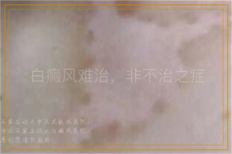 白癜风难治，非不治之症