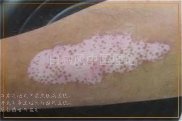 白癜风中医理论