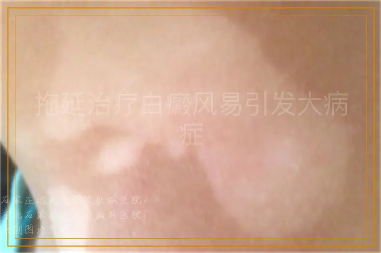 拖延治疗白癜风易引发大病症