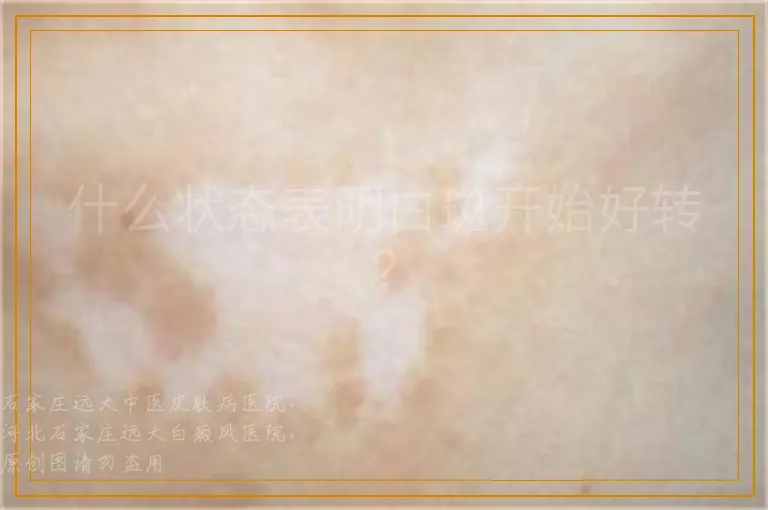 什么状态表明白斑开始好转？