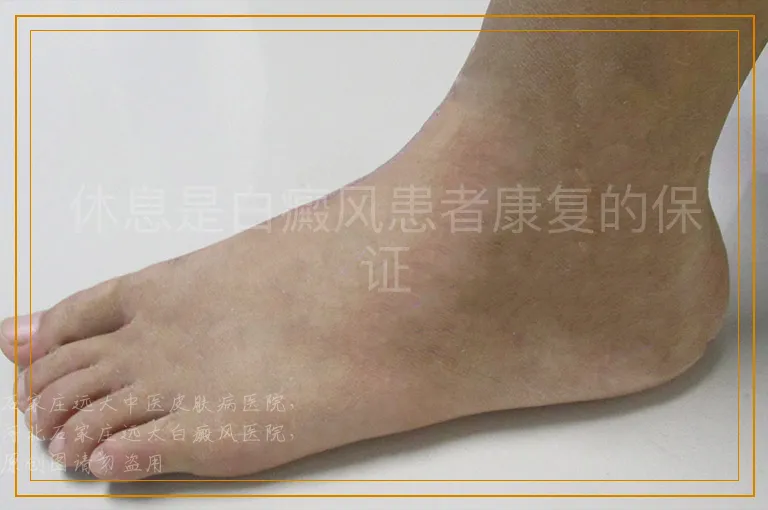 休息是白癜风患者康复的保证