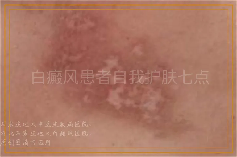 白癜风患者自我护肤七点