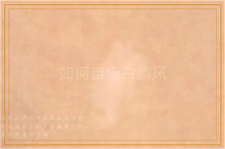 如何自查白癜风