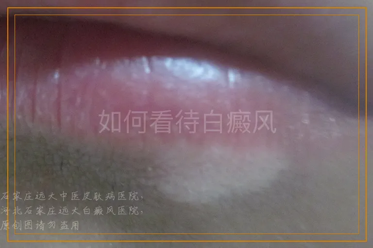 如何看待白癜风