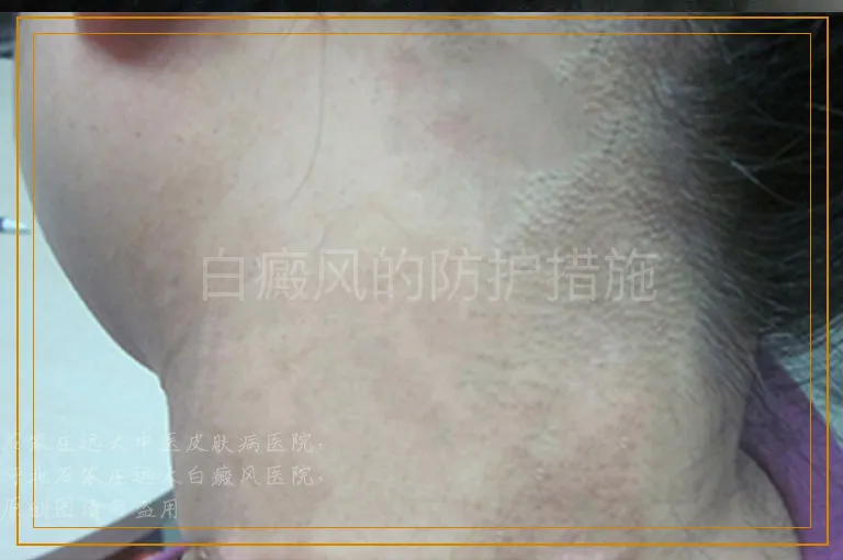 白癜风的防护措施