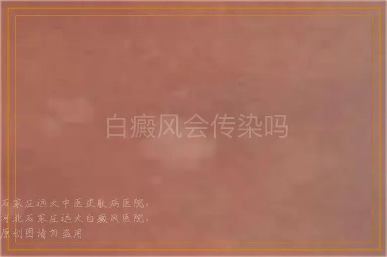 白癜风会传染吗