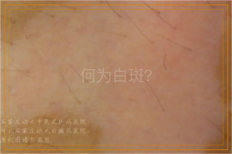 何为白斑？