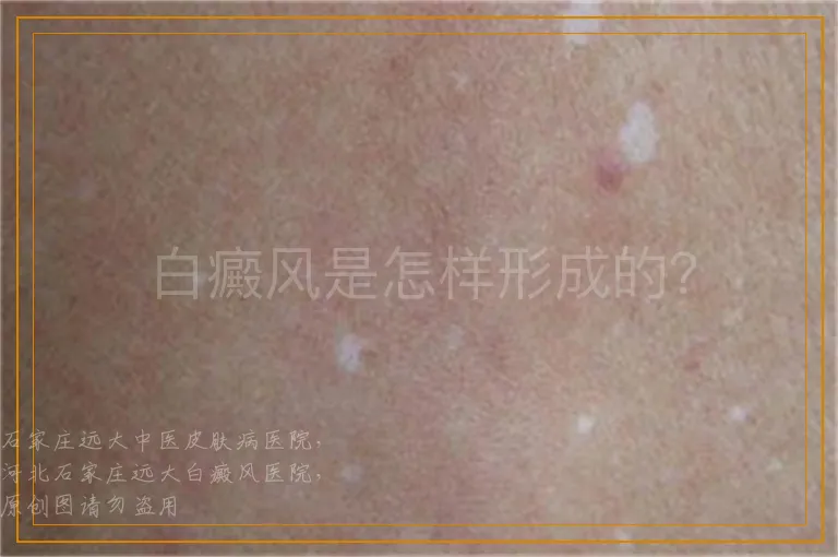 白癜风是怎样形成的？