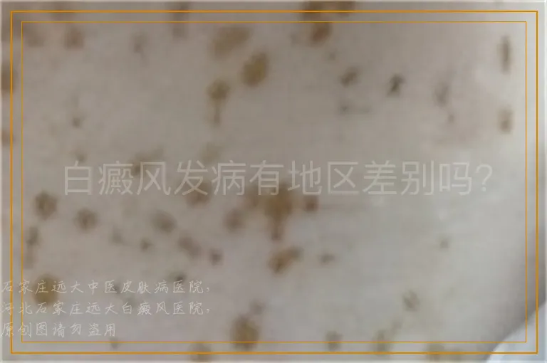 白癜风发病有地区差别吗？