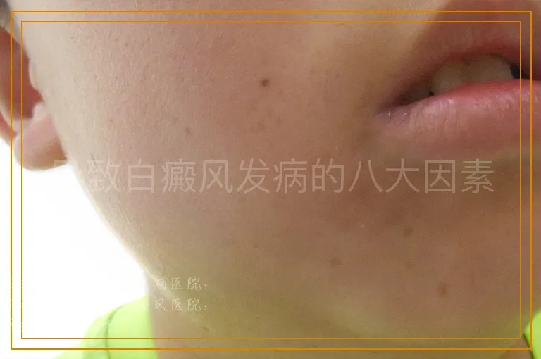 导致白癜风发病的八大因素
