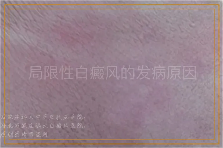 局限性白癜风的发病原因