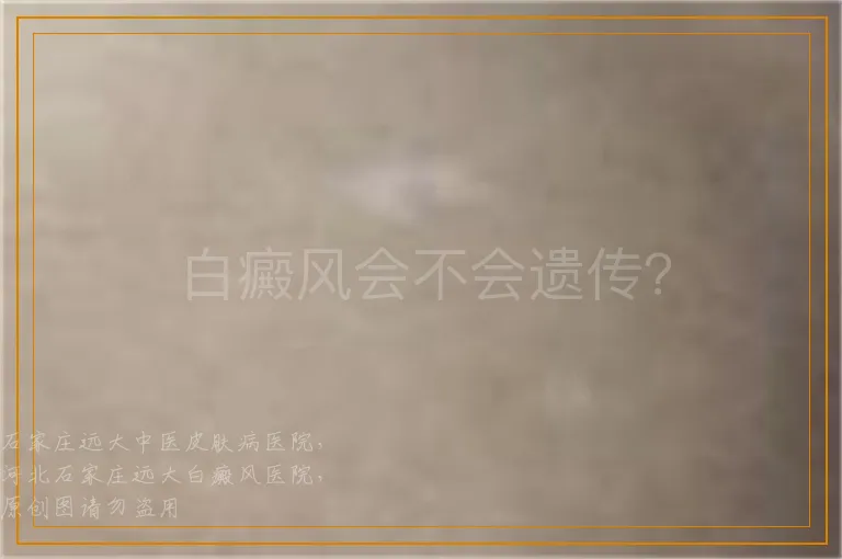 白癜风会不会遗传？