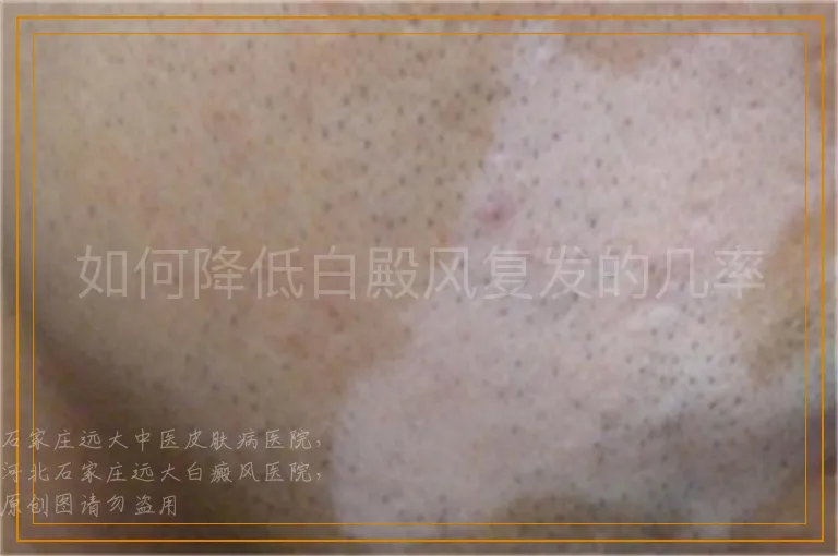 如何降低白殿风复发的几率