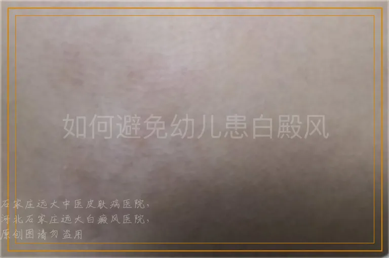 如何避免幼儿患白殿风