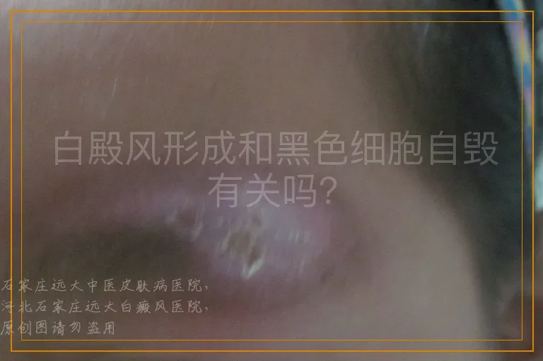 白殿风形成和黑色细胞自毁有关吗？