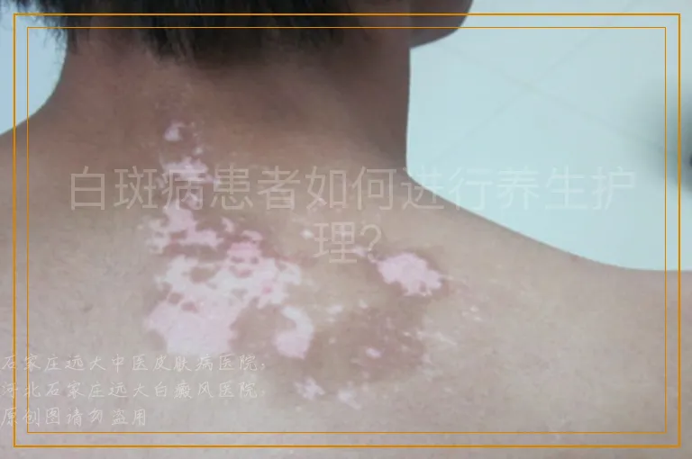 白斑病患者如何进行养生护理？