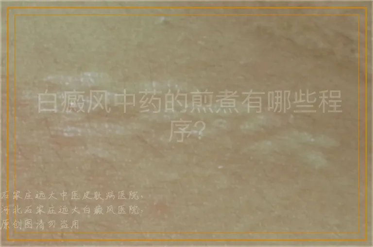 <strong>白癜风中药的煎煮有哪些程序？</strong>
