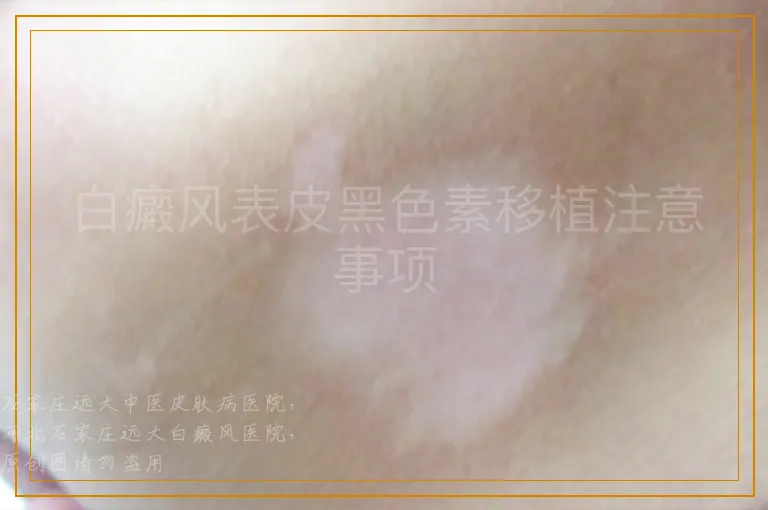 白癜风表皮黑色素移植注意事项