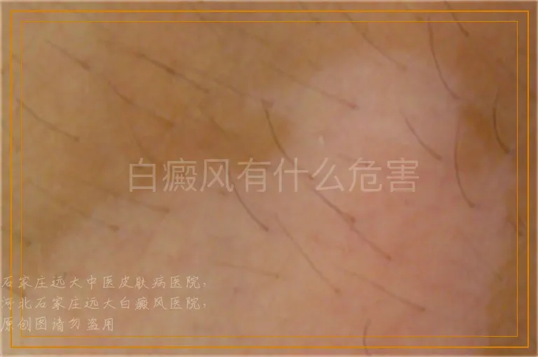 白癜风有什么危害