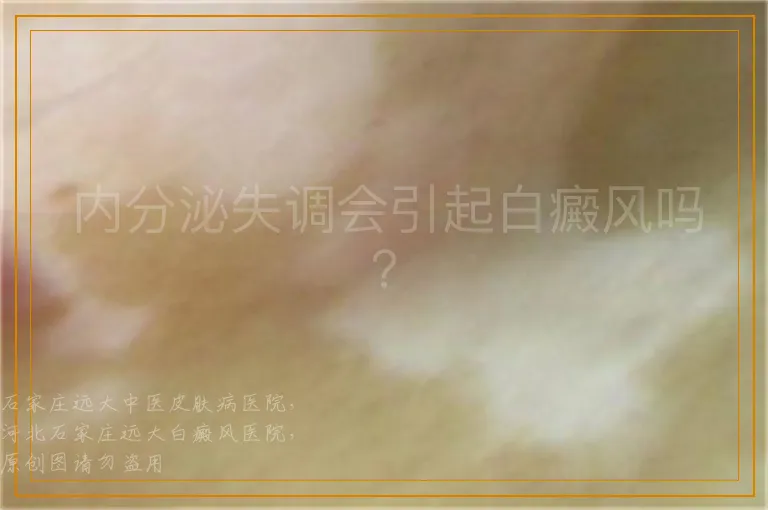 内分泌失调会引起白癜风吗？