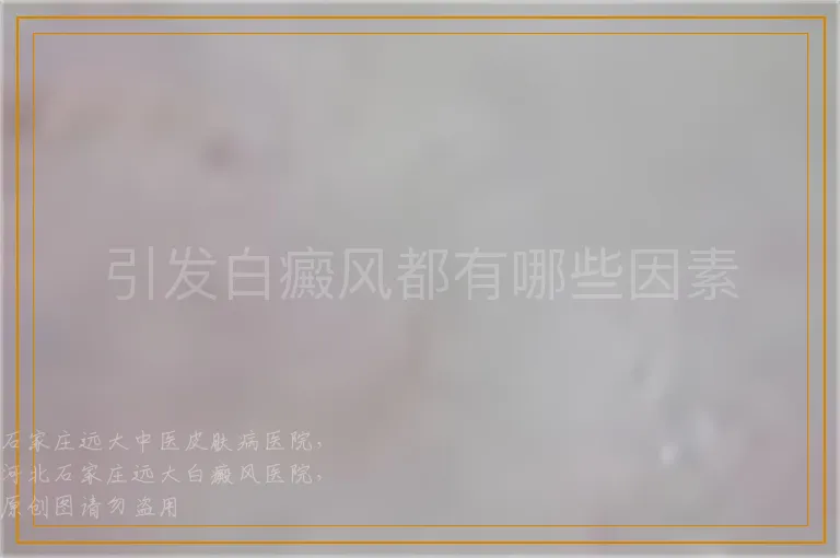 引发白癜风都有哪些因素