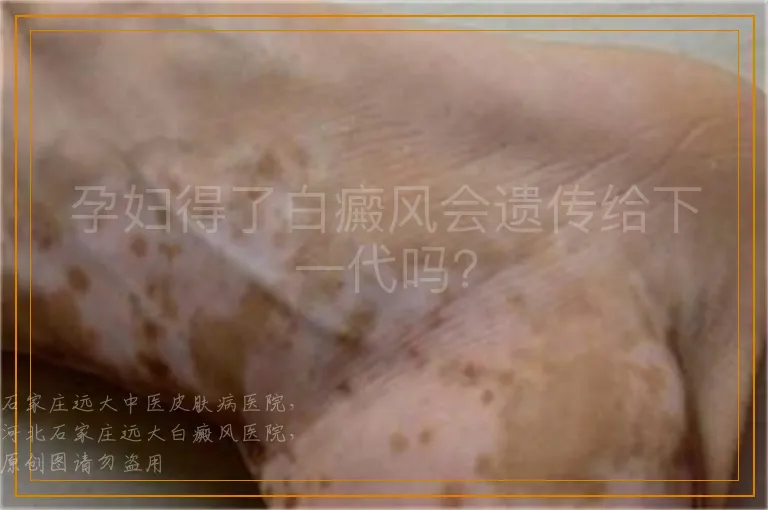 孕妇得了白癜风会遗传给下一代吗？