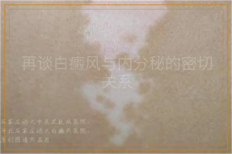 再谈白癜风与内分秘的密切关系
