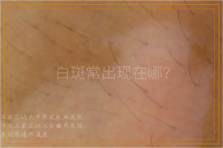 白斑常出现在哪？